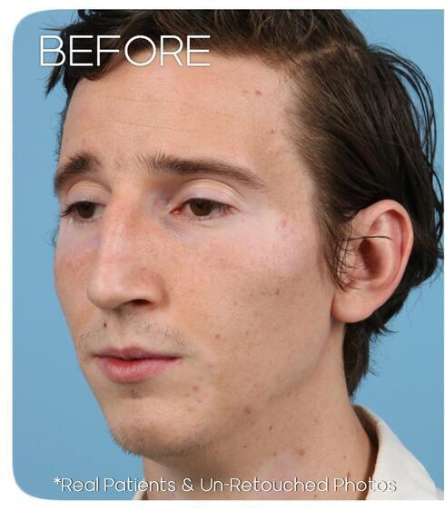 Rhinoplasty Before & After Image