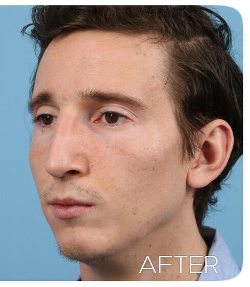 Rhinoplasty Before & After Image