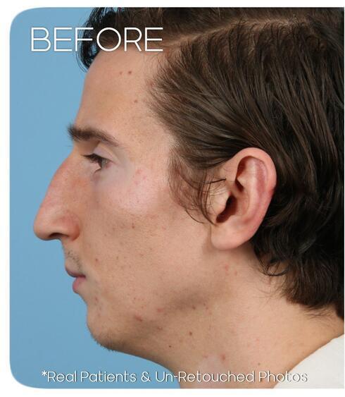 Rhinoplasty Before & After Image