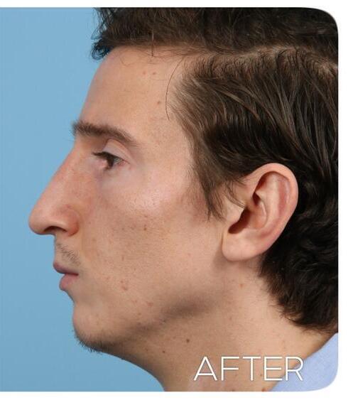 Rhinoplasty Before & After Image