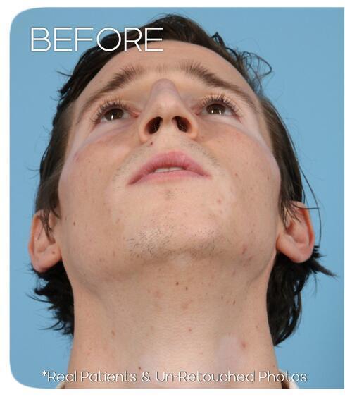 Rhinoplasty Before & After Image