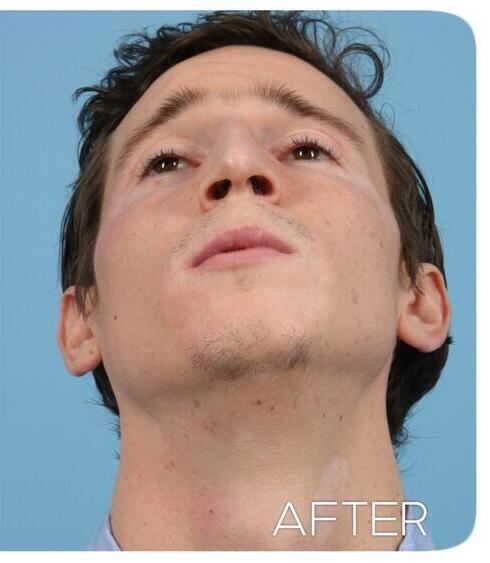 Rhinoplasty Before & After Image