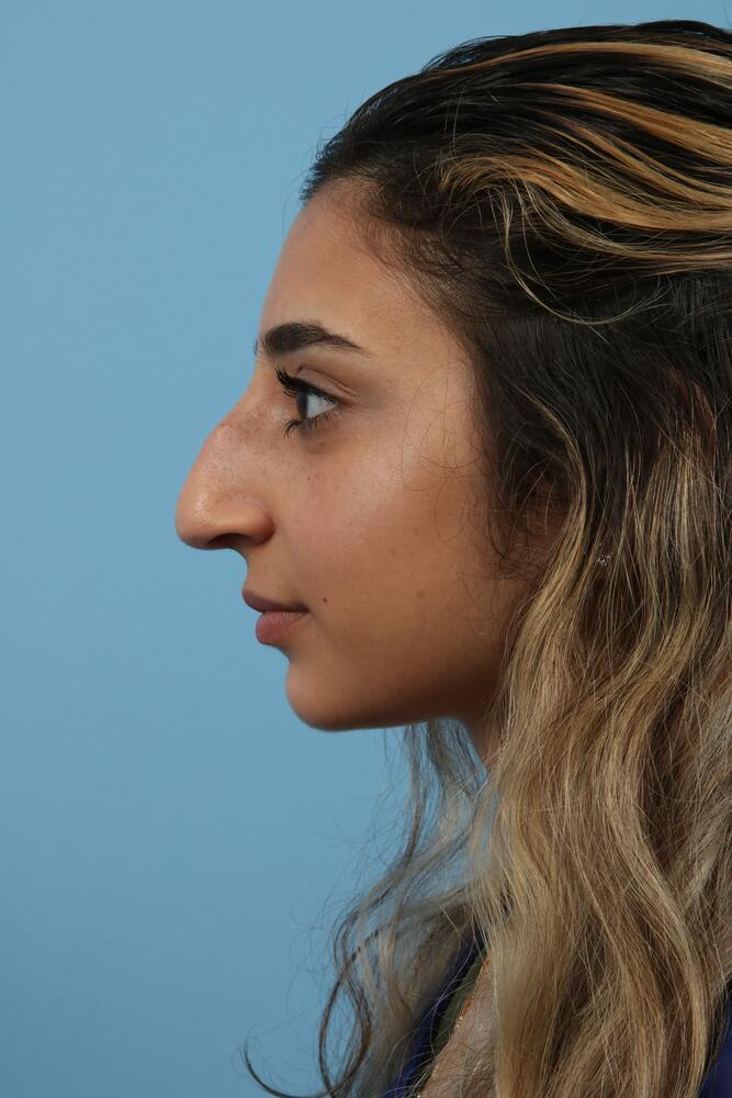 Rhinoplasty Before & After Image