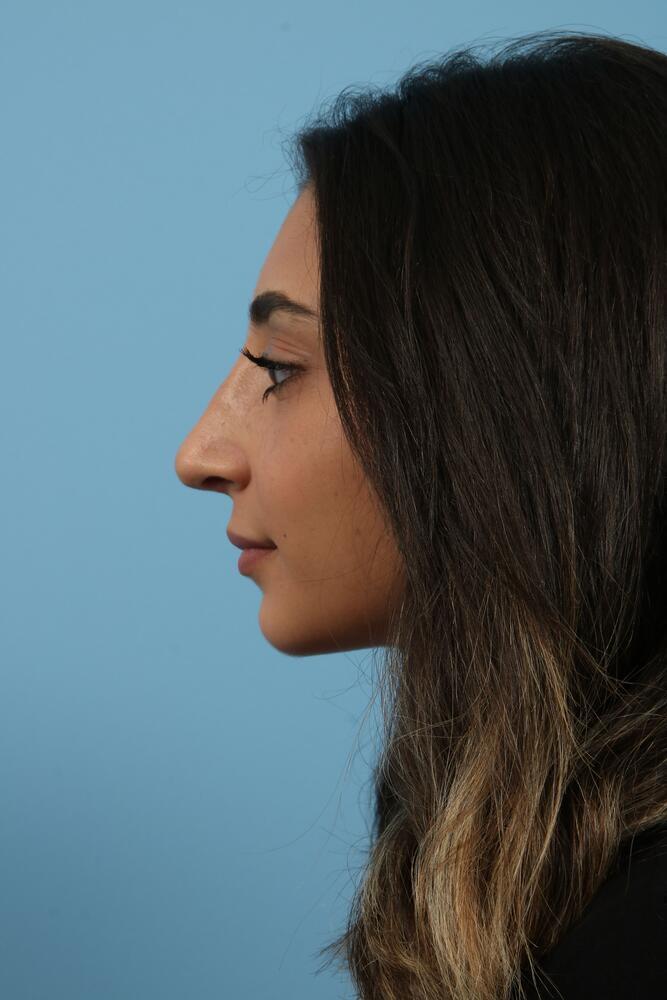 Rhinoplasty Before & After Image