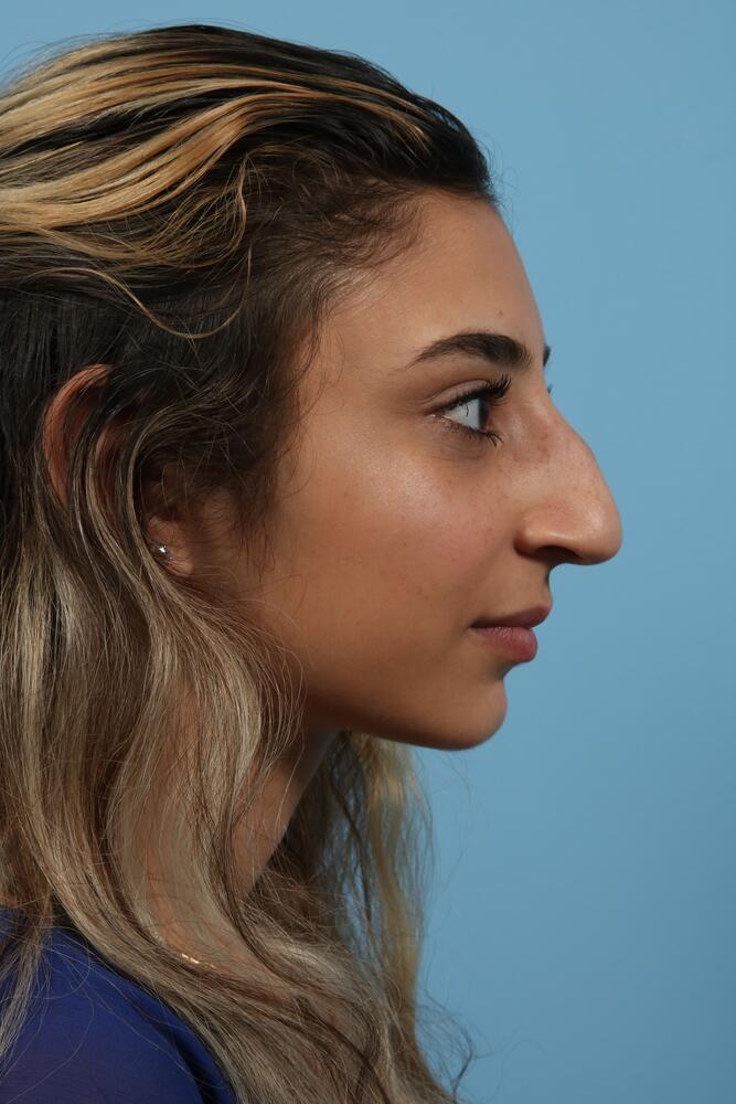 Rhinoplasty Before & After Image