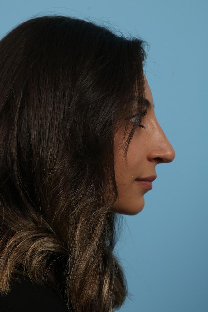 Rhinoplasty Before & After Image