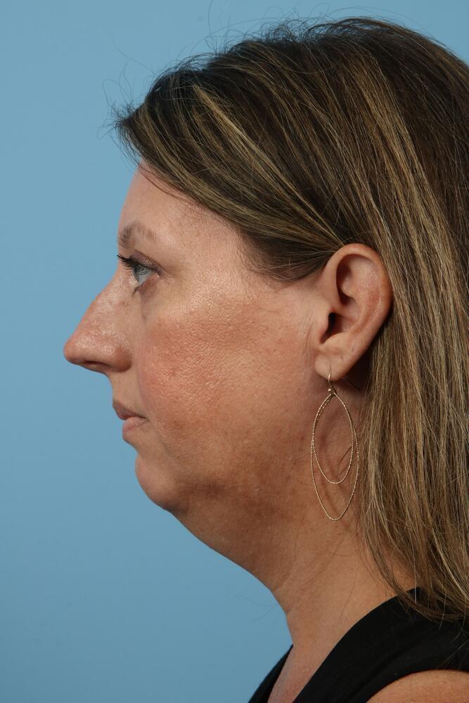 Rhinoplasty Before & After Image