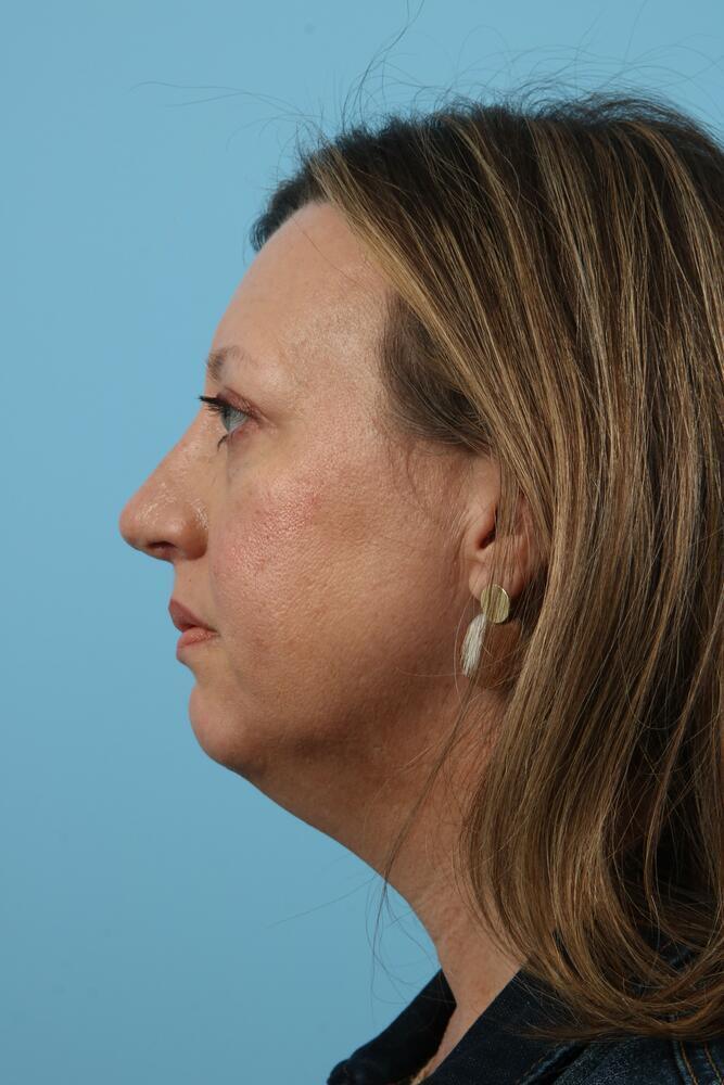 Rhinoplasty Before & After Image