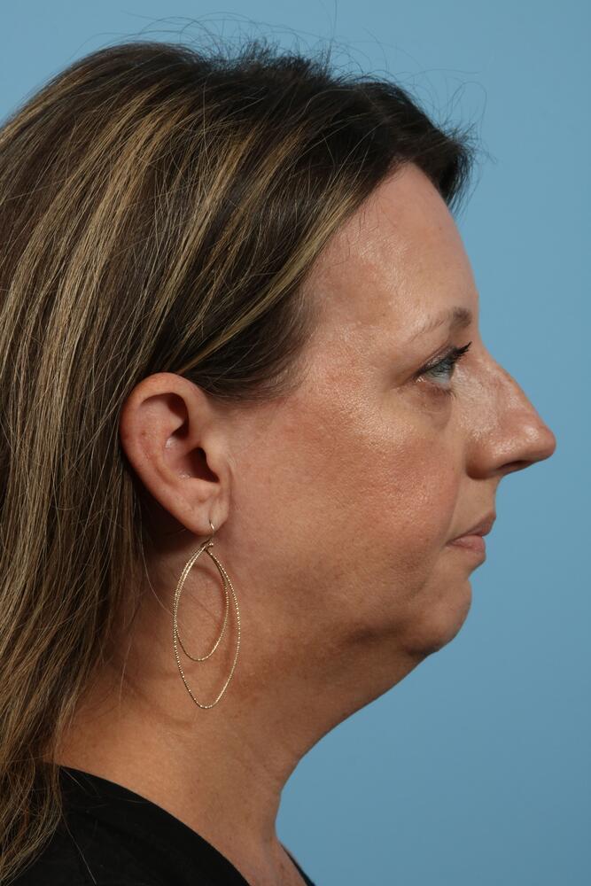 Rhinoplasty Before & After Image