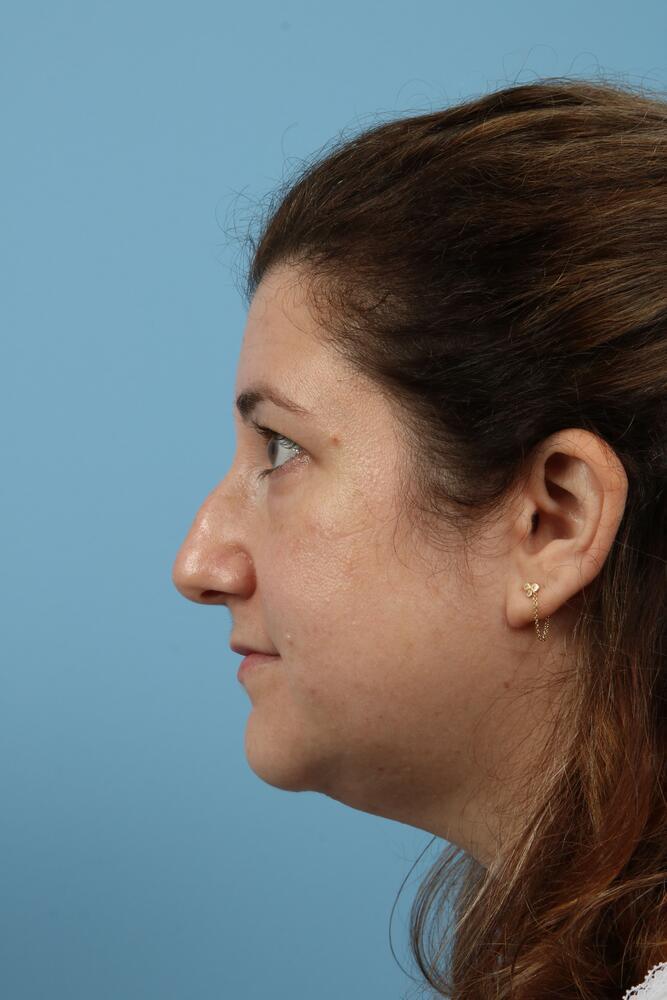 Rhinoplasty Before & After Image