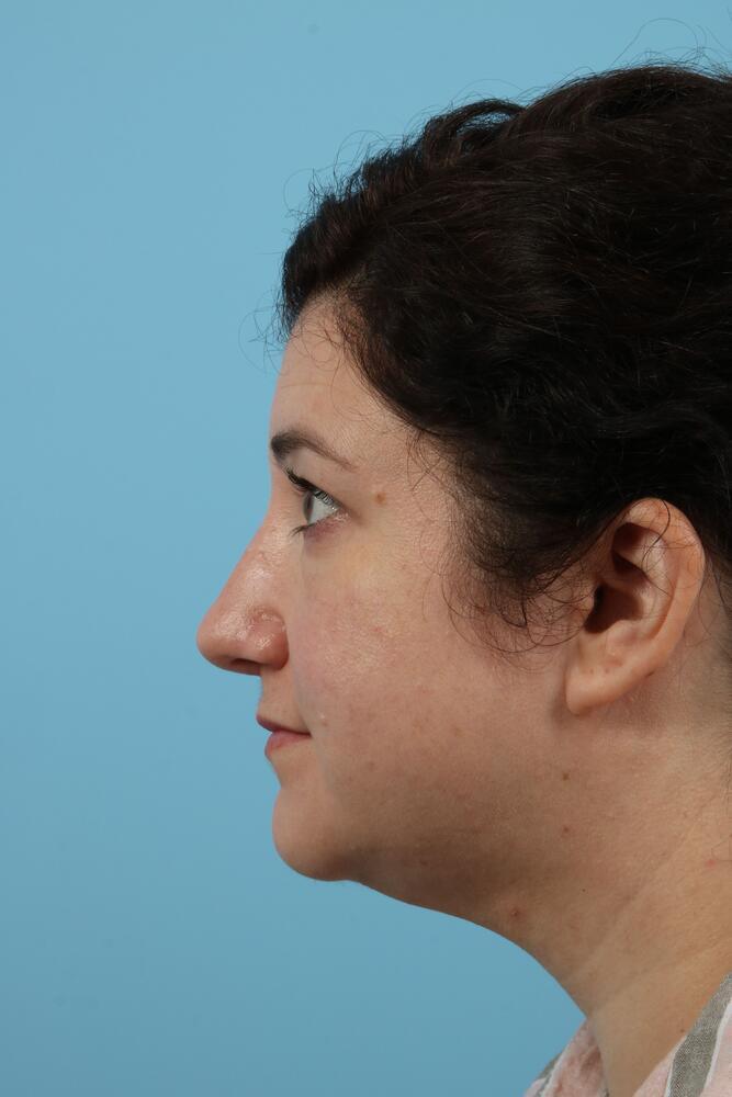 Rhinoplasty Before & After Image