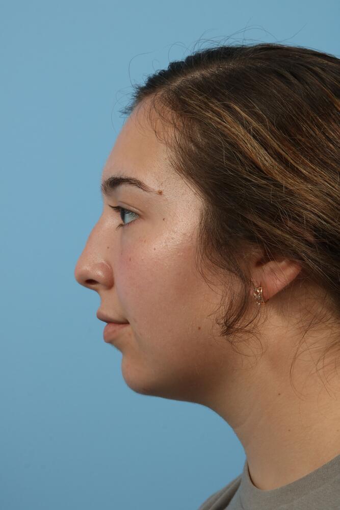 Rhinoplasty Before & After Image