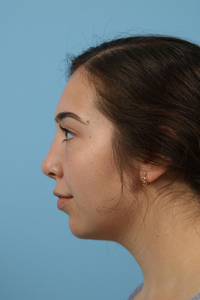 Rhinoplasty Before & After Image