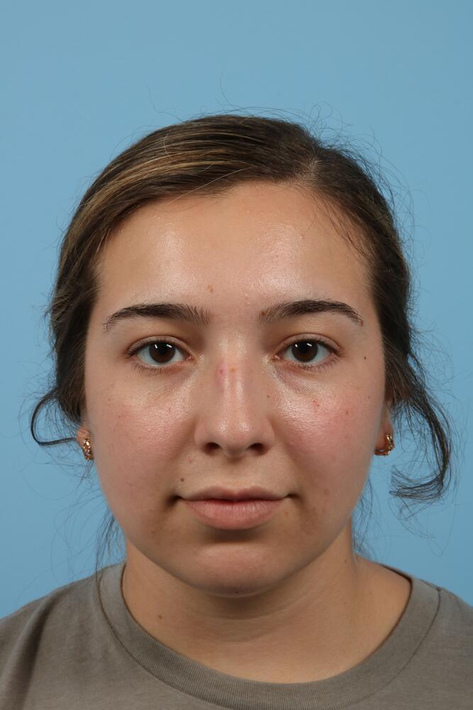 Rhinoplasty Before & After Image