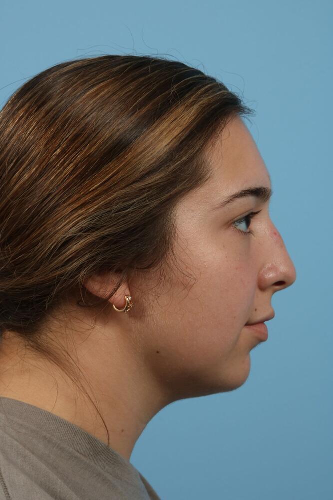 Rhinoplasty Before & After Image