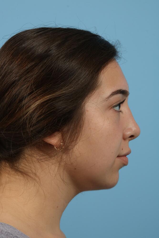 Rhinoplasty Before & After Image