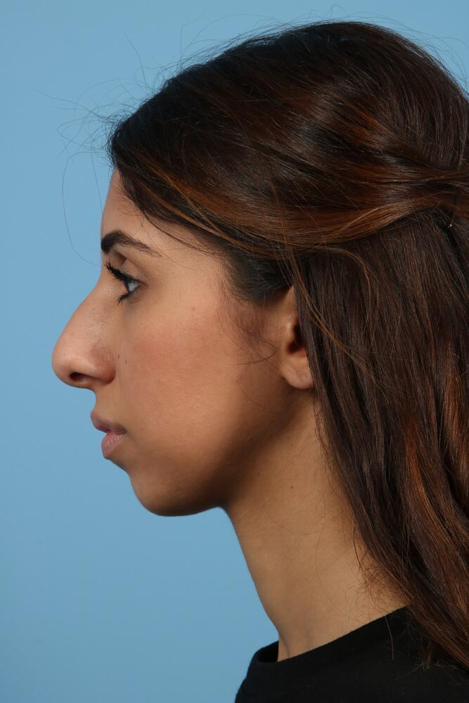 Rhinoplasty Before & After Image