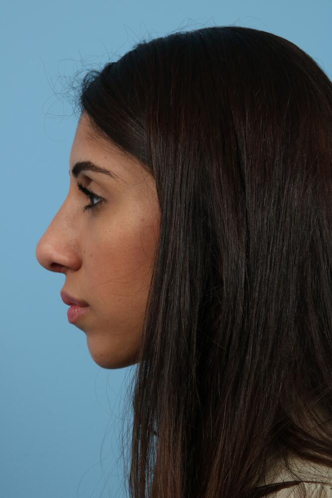 Rhinoplasty Before & After Image