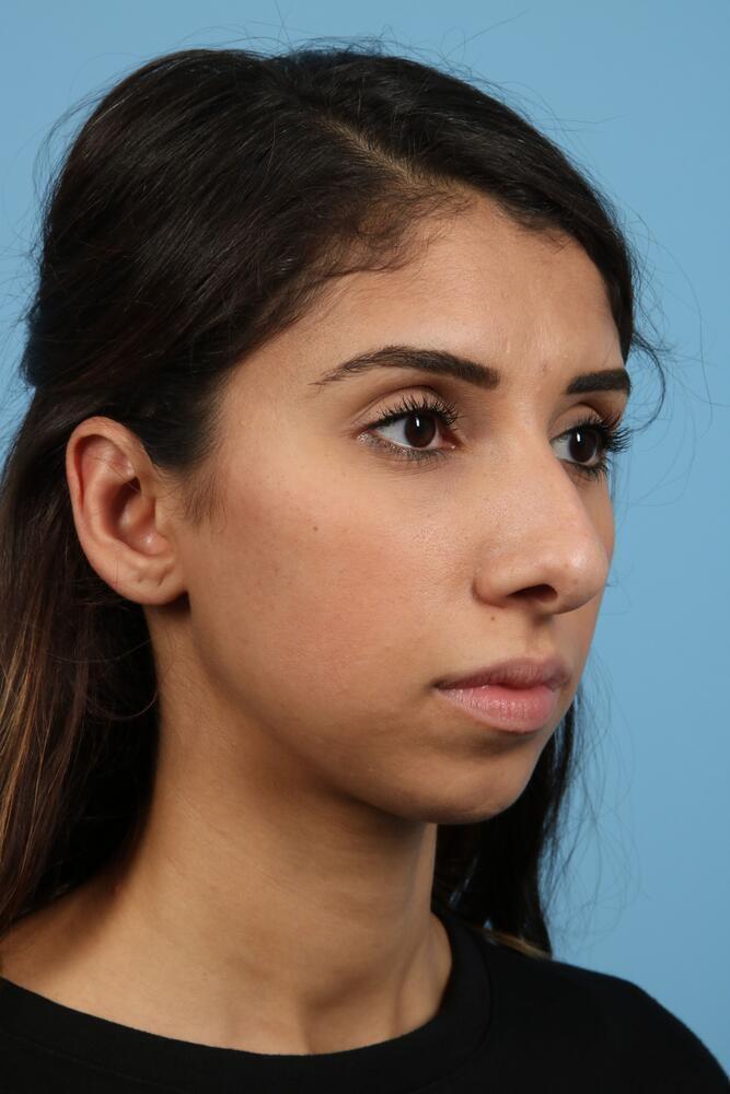 Rhinoplasty Before & After Image