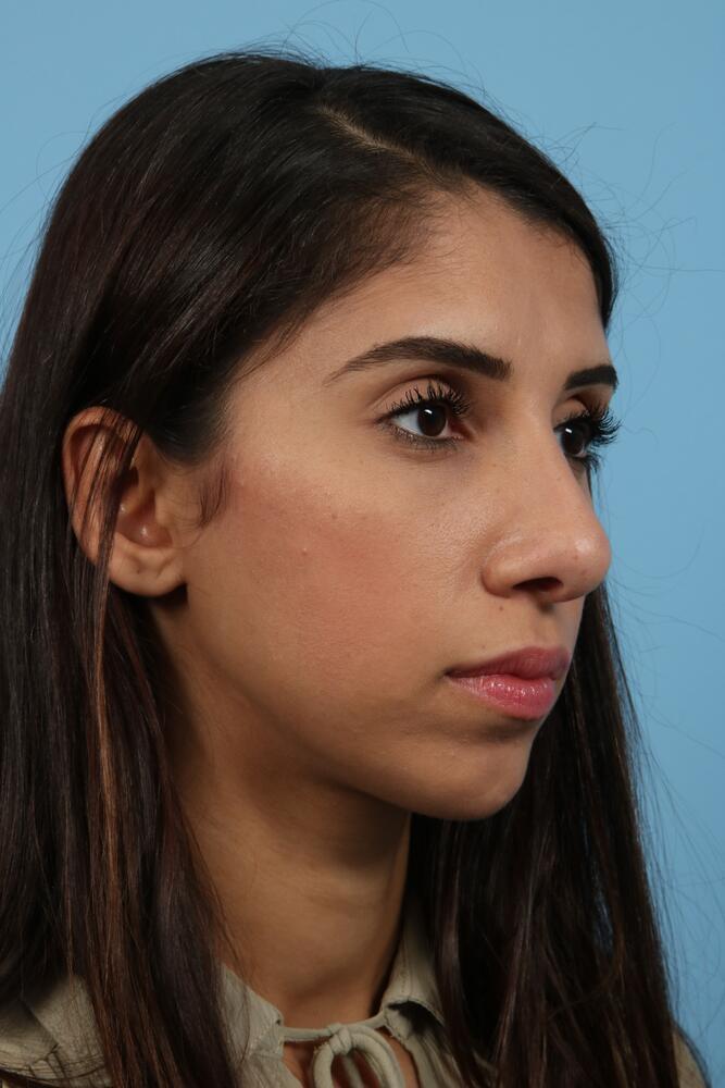 Rhinoplasty Before & After Image