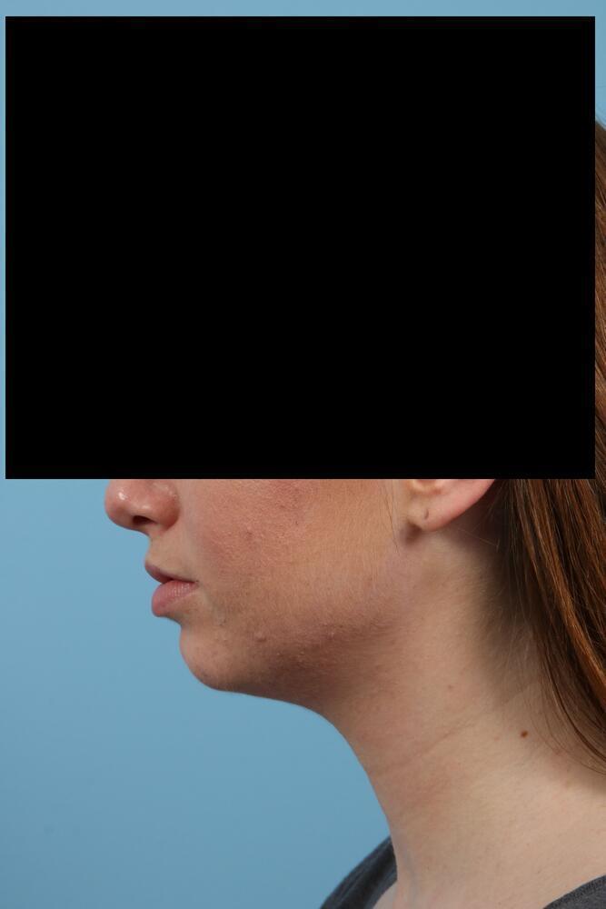 Chin Implants Before & After Image