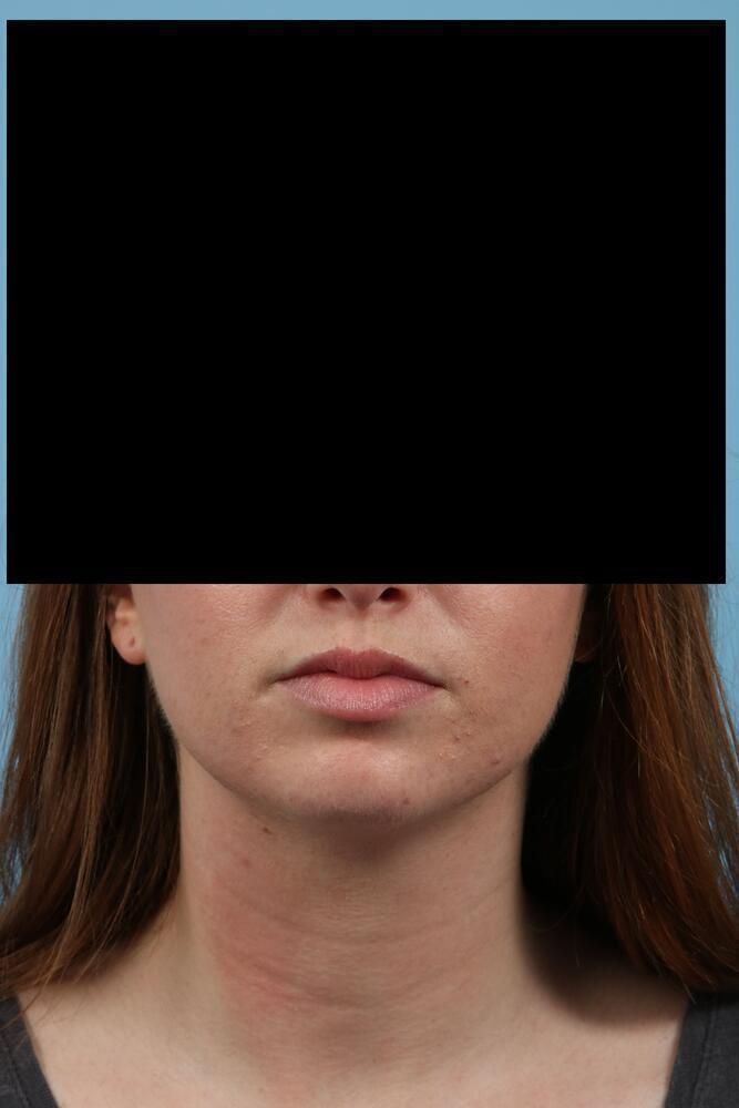 Chin Implants Before & After Image