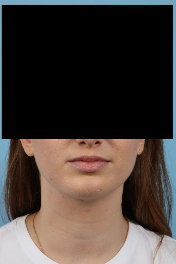 Chin Implants Before & After Image