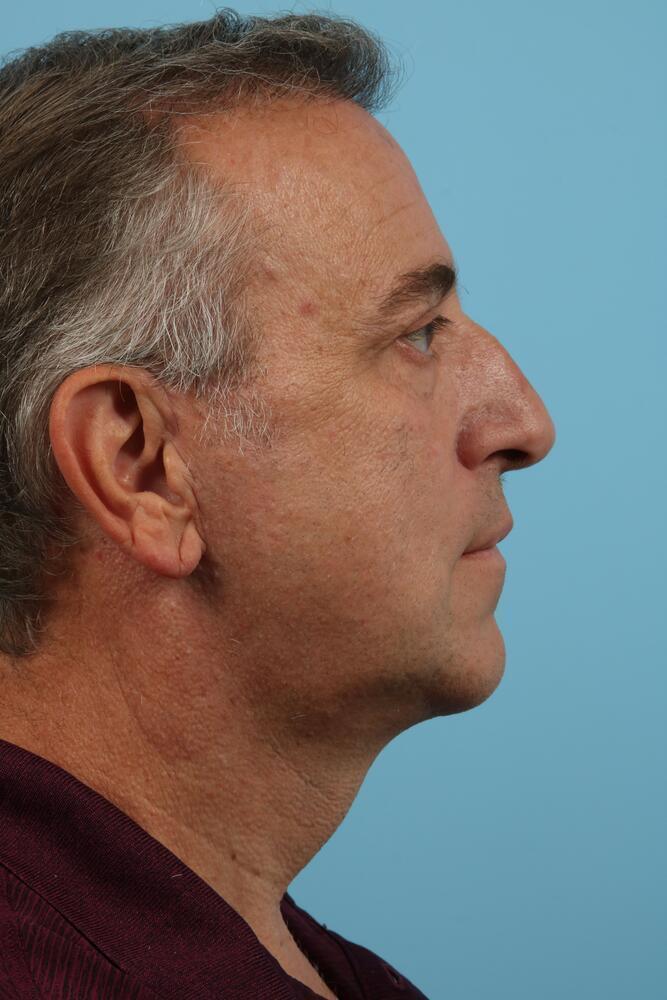 Chin Implants Before & After Image