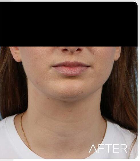 Facial Refinement Before & After Image