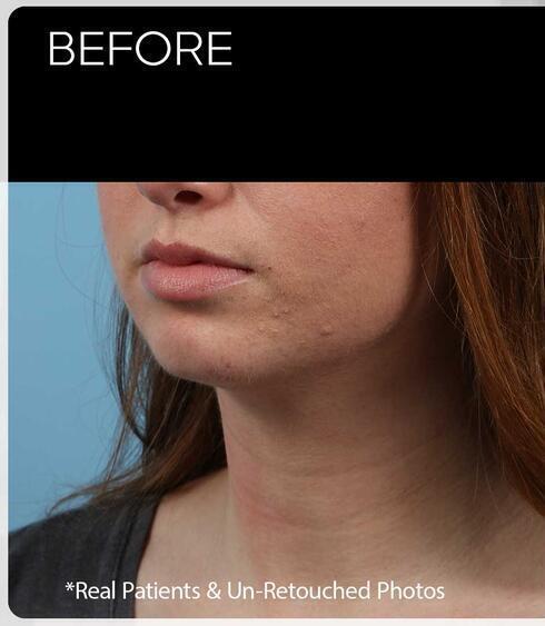 Facial Refinement Before & After Image