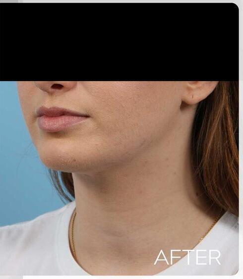 Facial Refinement Before & After Image