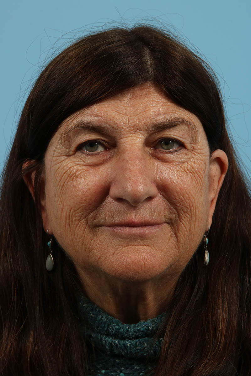 Blepharoplasty Before & After Image