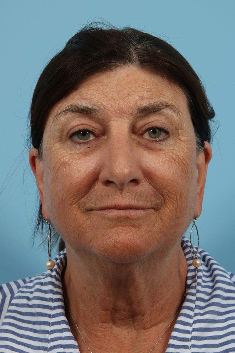 Blepharoplasty Before & After Image