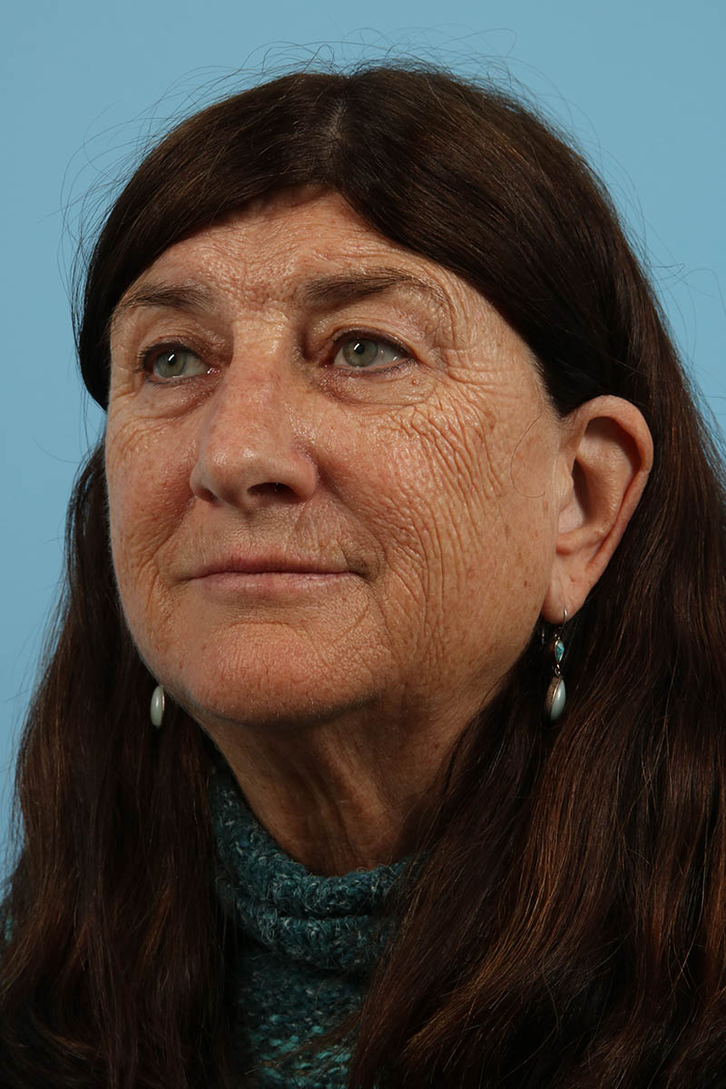 Blepharoplasty Before & After Image