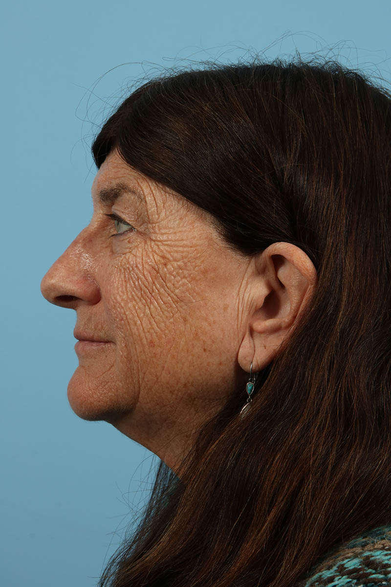 Blepharoplasty Before & After Image