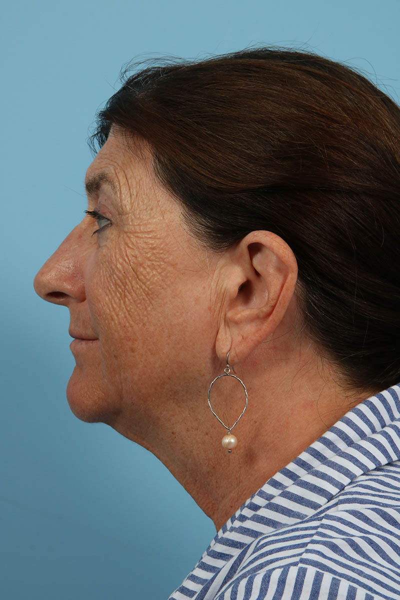 Blepharoplasty Before & After Image