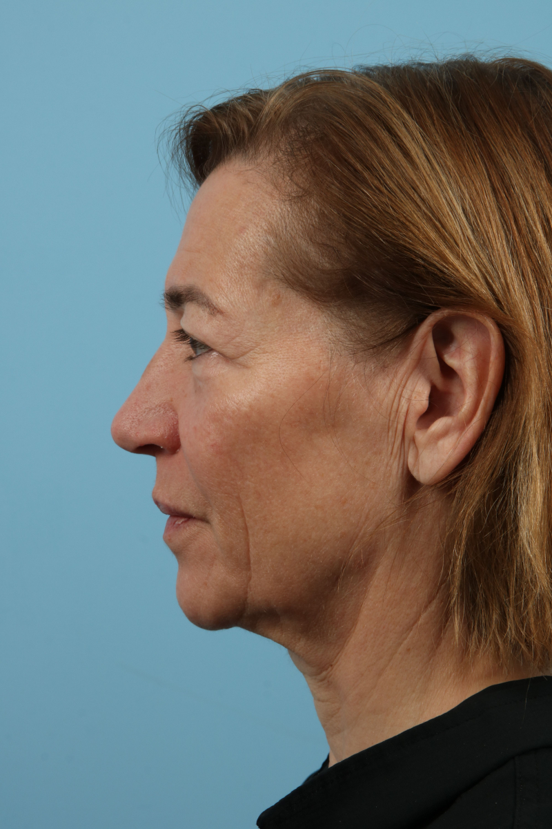 Blepharoplasty Before & After Image