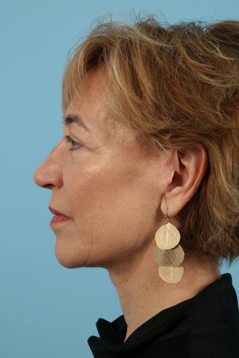 Blepharoplasty Before & After Image