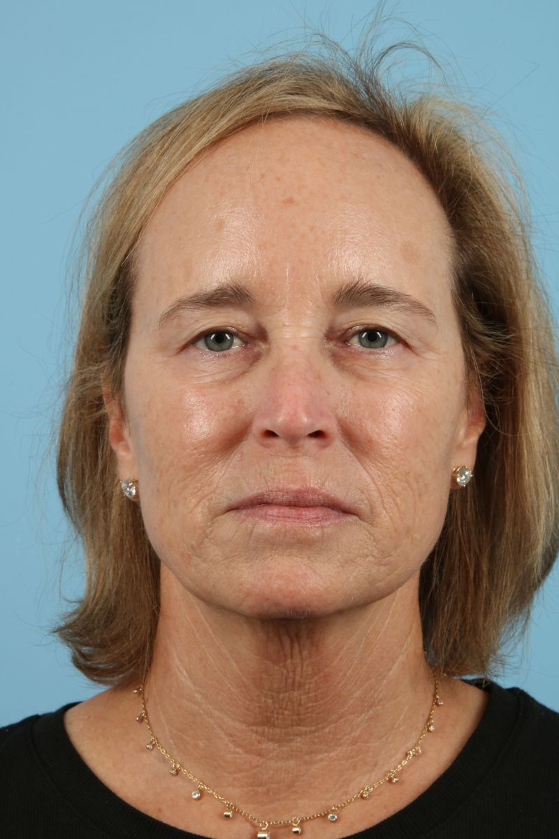 Blepharoplasty Before & After Image