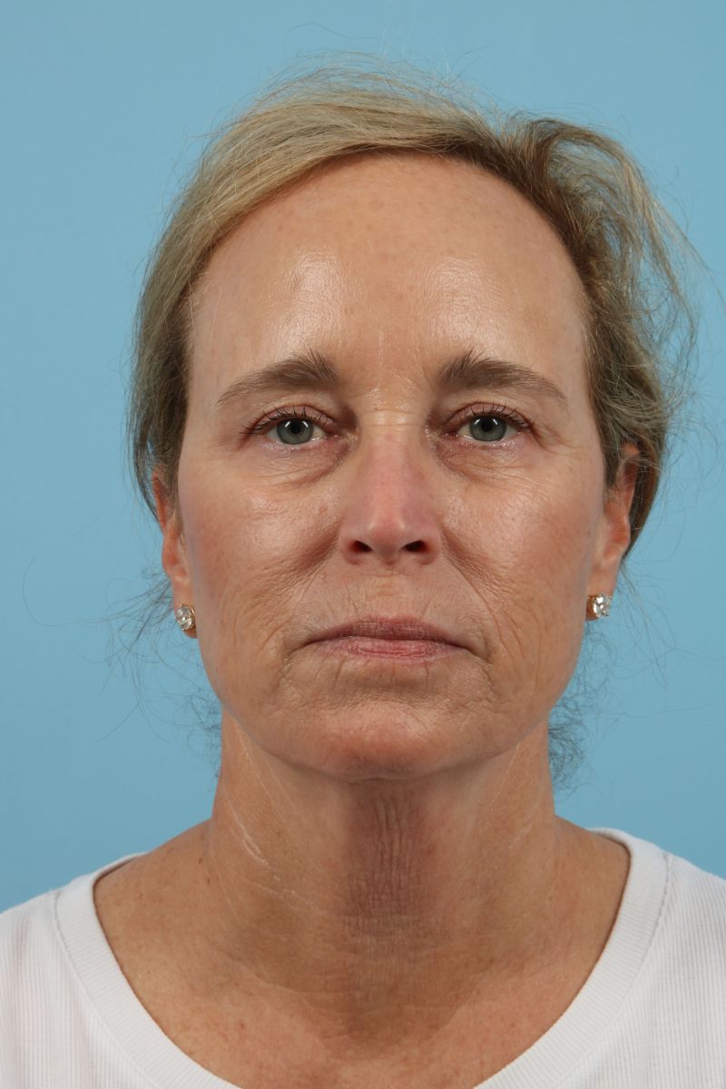 Blepharoplasty Before & After Image