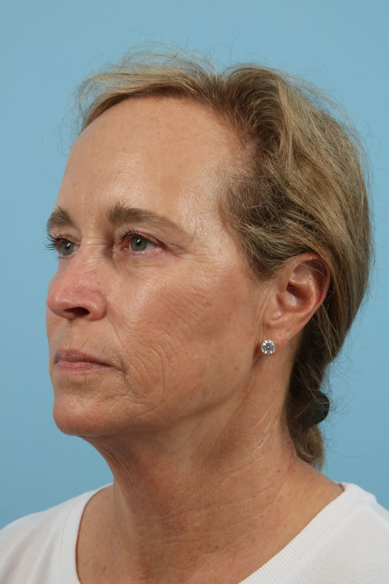 Blepharoplasty Before & After Image