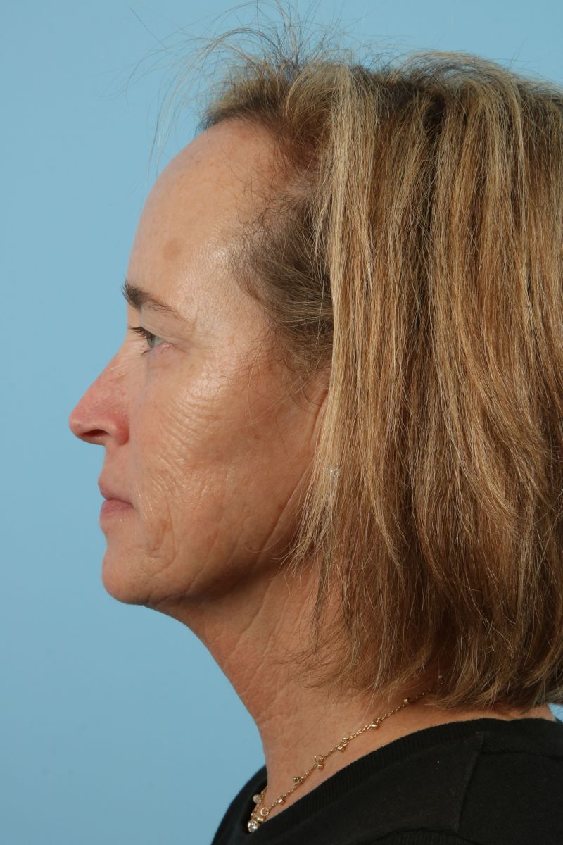 Blepharoplasty Before & After Image