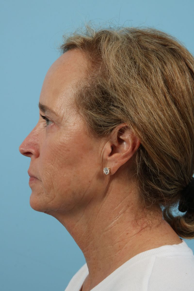 Blepharoplasty Before & After Image