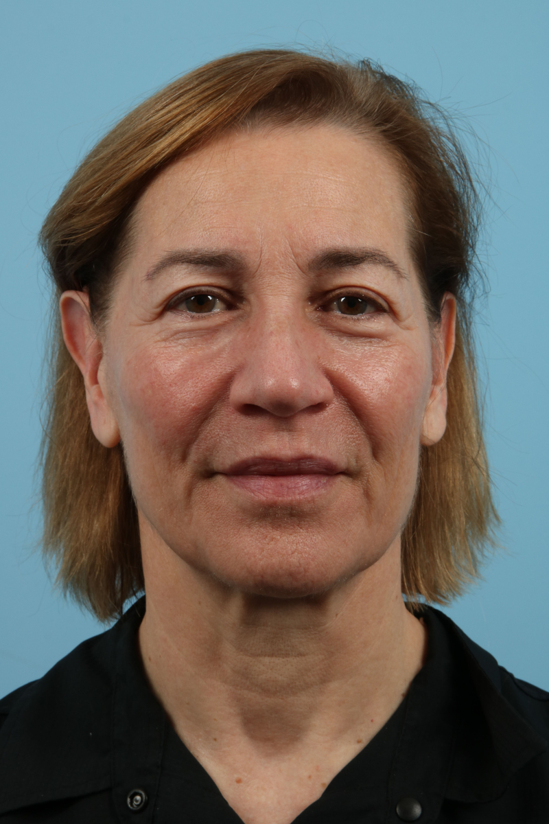 Facelifts Before & After Image