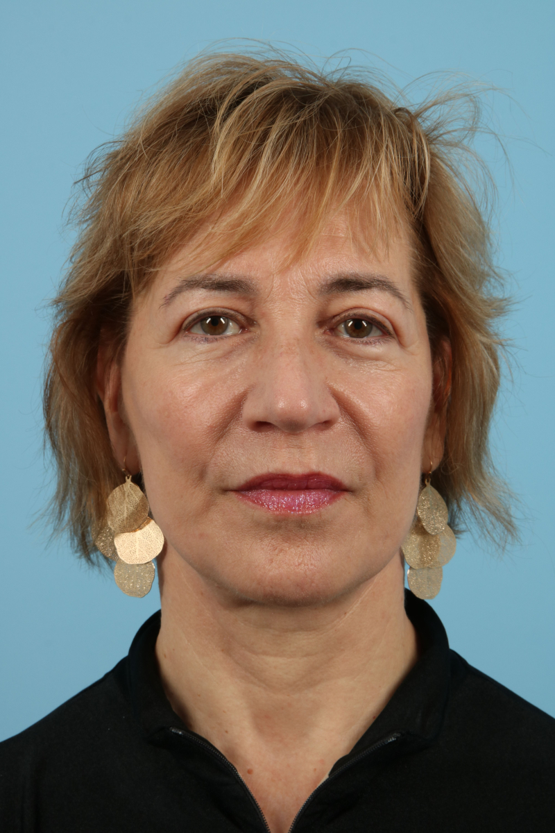 Facelifts Before & After Image