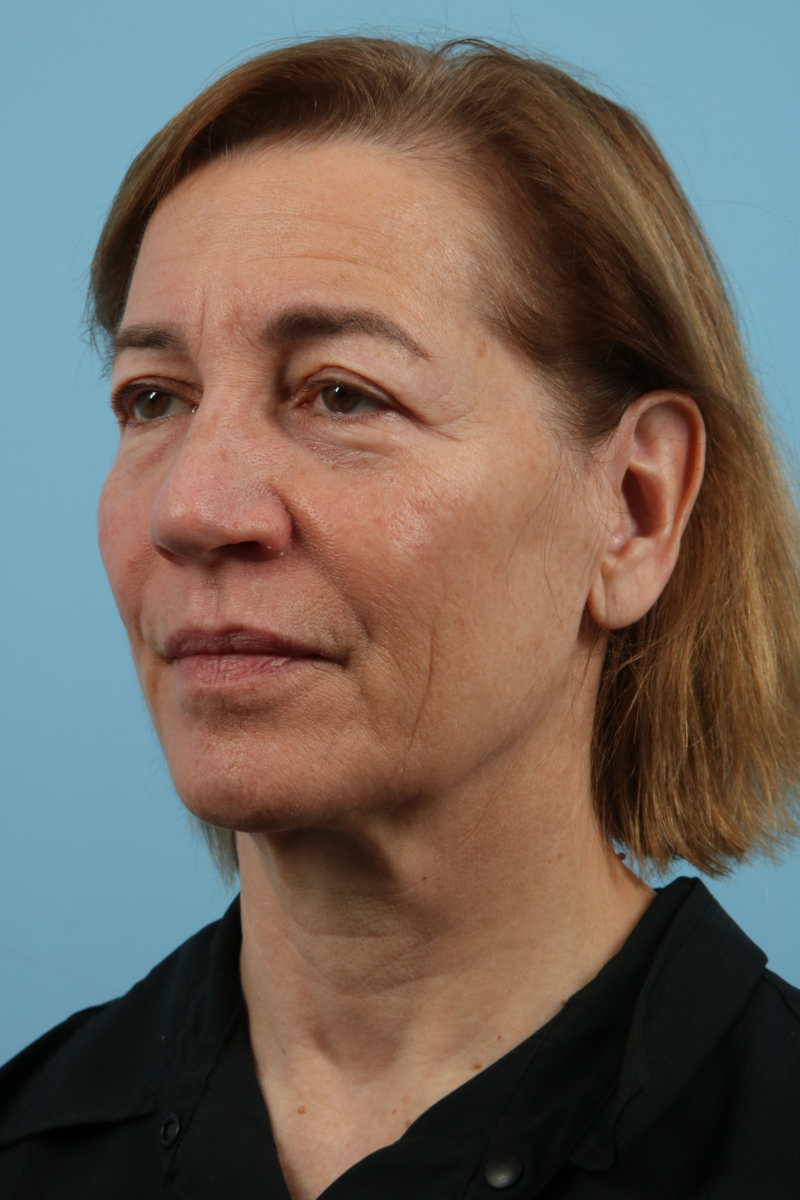 Facelifts Before & After Image