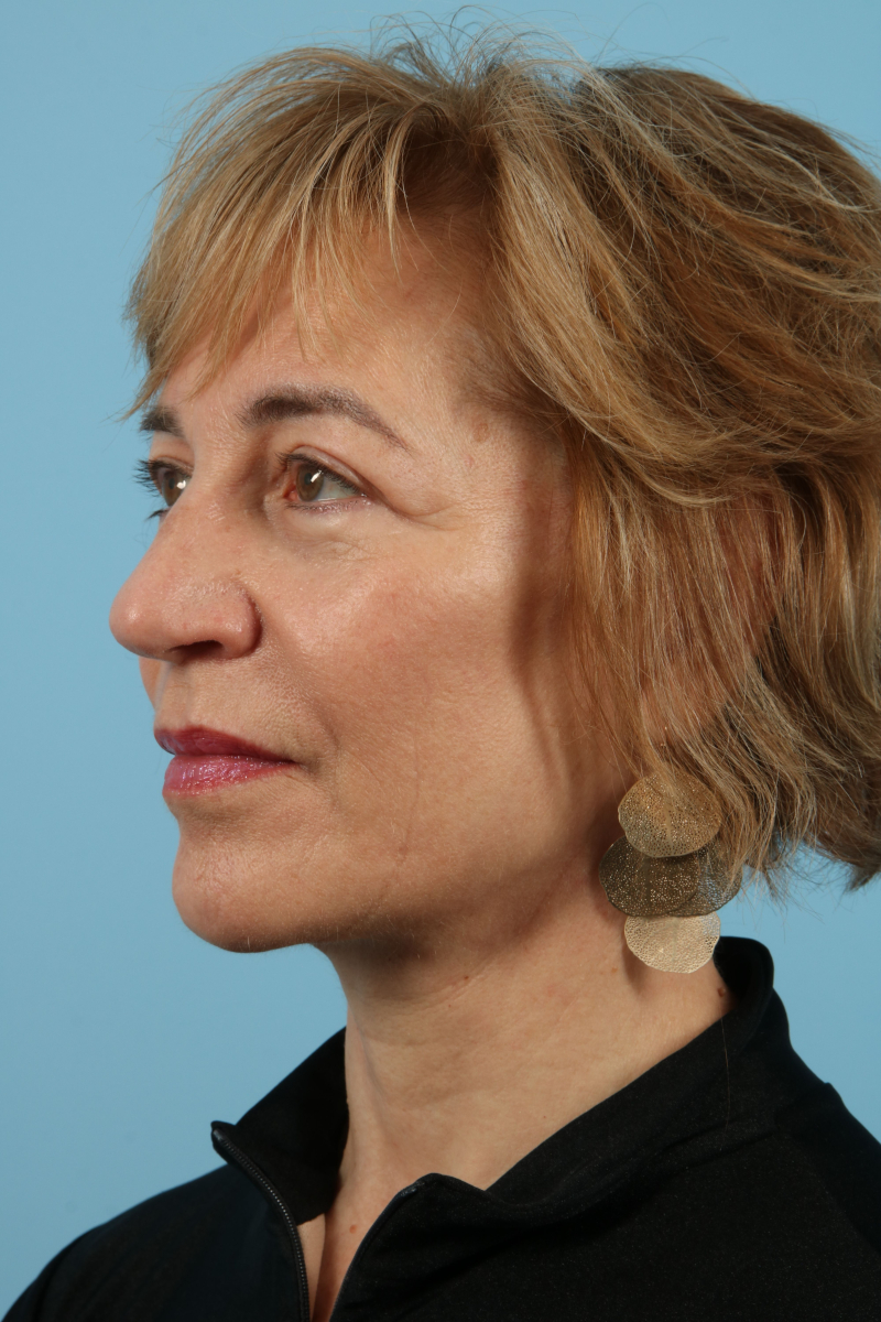 Facelifts Before & After Image