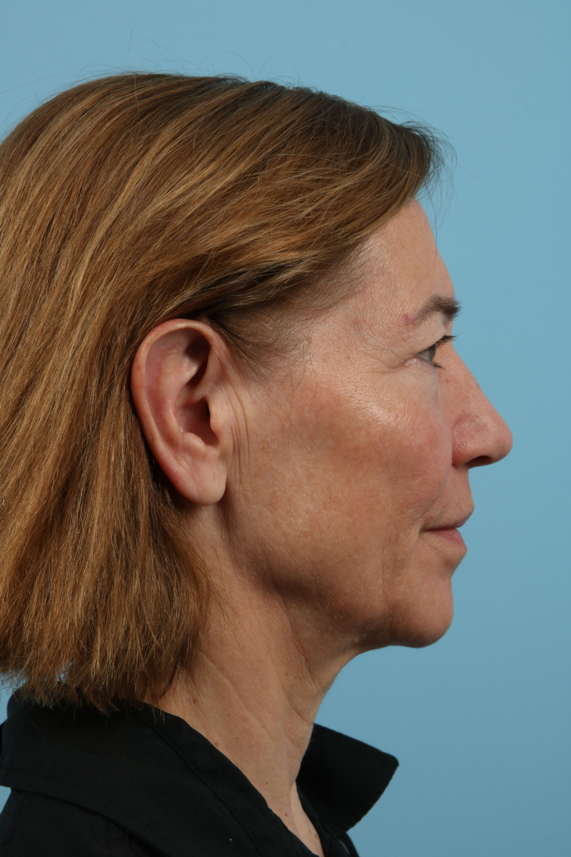 Facelifts Before & After Image