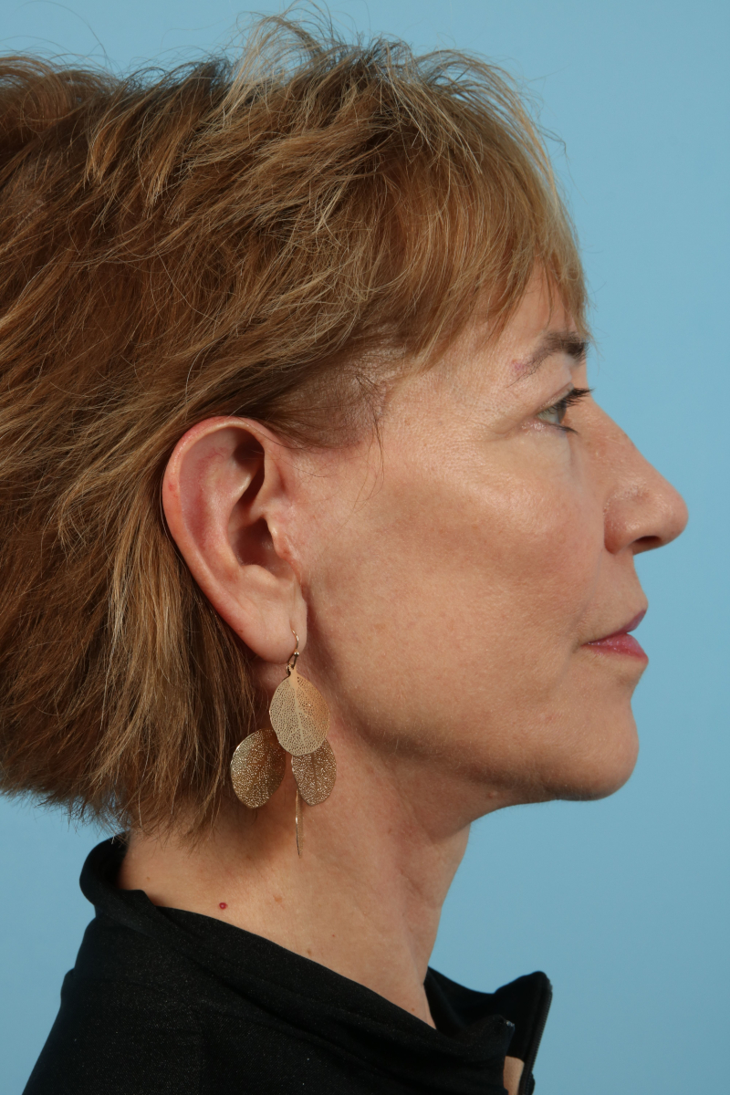 Facelifts Before & After Image