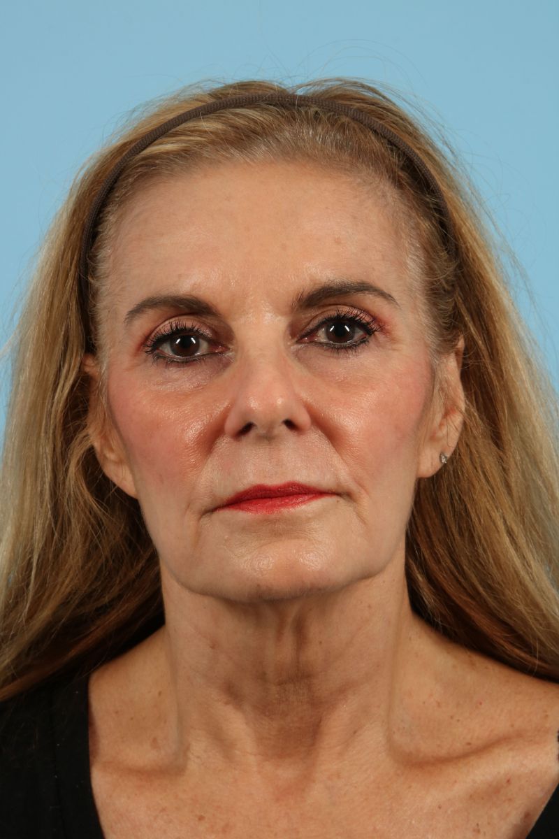 Facelifts Before & After Image